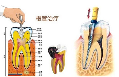 南京牙齿根管治疗是怎么回事