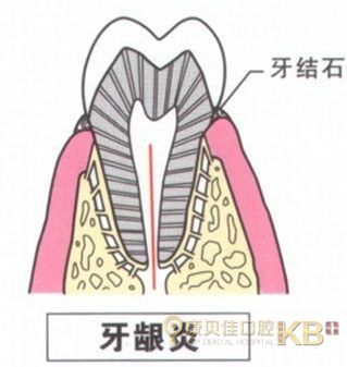 南京去除牙结石的方法