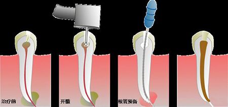 对付牙痛有哪些措施？ 